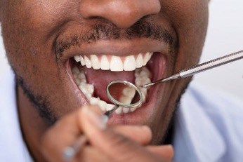 fillings