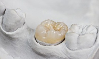 inlays_and_onlays