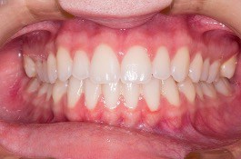 periodontal_screening