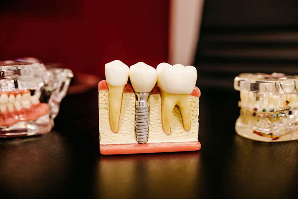 root_canal