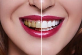 teeth_whitening